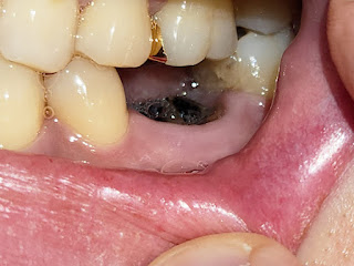 치아-뿌리-염증-충치