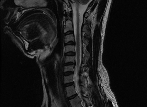 Read more about the article 경추성 목디스크 두통 주사치료 후기 및 지속기간