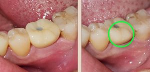 Read more about the article 임플란트 후 통증 치아 잇몸 어디에 생겼나?