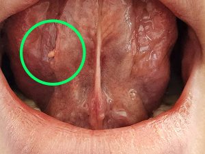 Read more about the article 혀 밑 돌기 생기고 통증 구내염 전조증상일까?