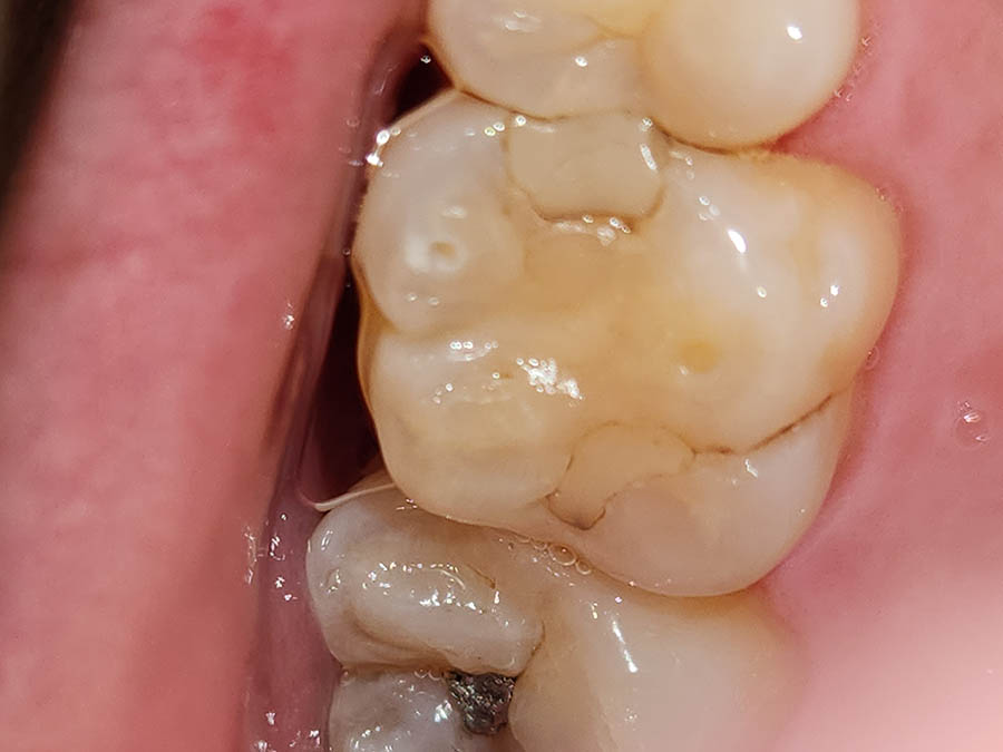 치아-구멍-충치-레진-치료