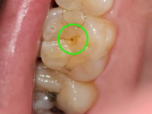 Read more about the article 치아 구멍 깨짐 후 생긴 충치 레진 치료 가격