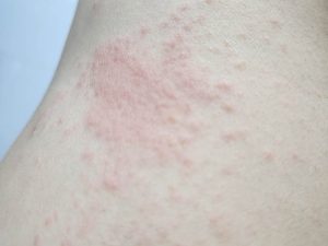 Read more about the article 여름 두드러기 치료 항히스타민제 처방 복용