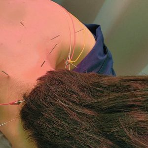 Read more about the article 만성 두통 한의원 도침 치료 후기