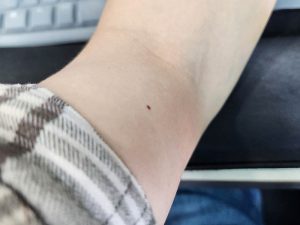 Read more about the article 목디스크 신경압박 의심 근전도 신경전도 검사 리뷰