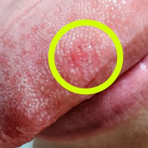 Read more about the article 심각한 통증 혓바늘 없애는 법 완벽 가이드